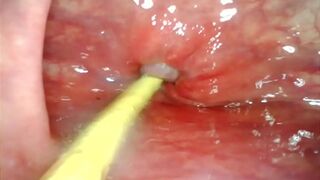 Intense Anal👌 DP: Camera Delves Deep Inside As My Massive Cock🍆 Drills And Leaves Her In高潮