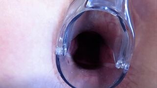 Stretching the anal and vagina with a gynecological speculum. MILF with a big butt and a gaping asshole and a gaping pussy.